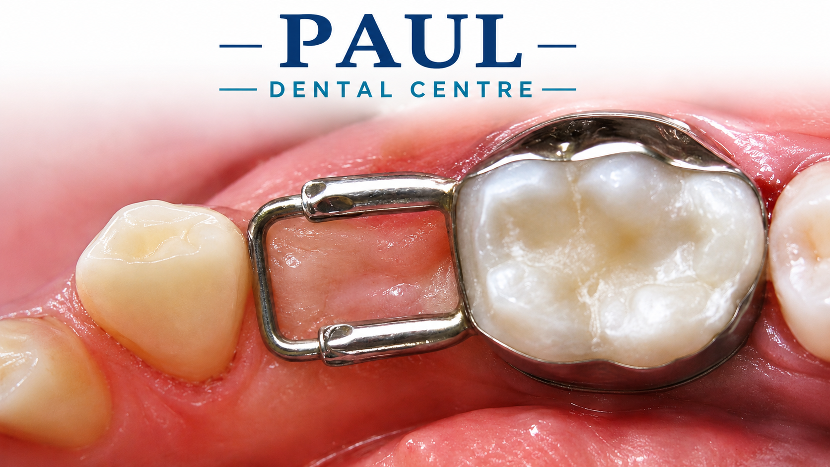 Stainless Steel Crowns